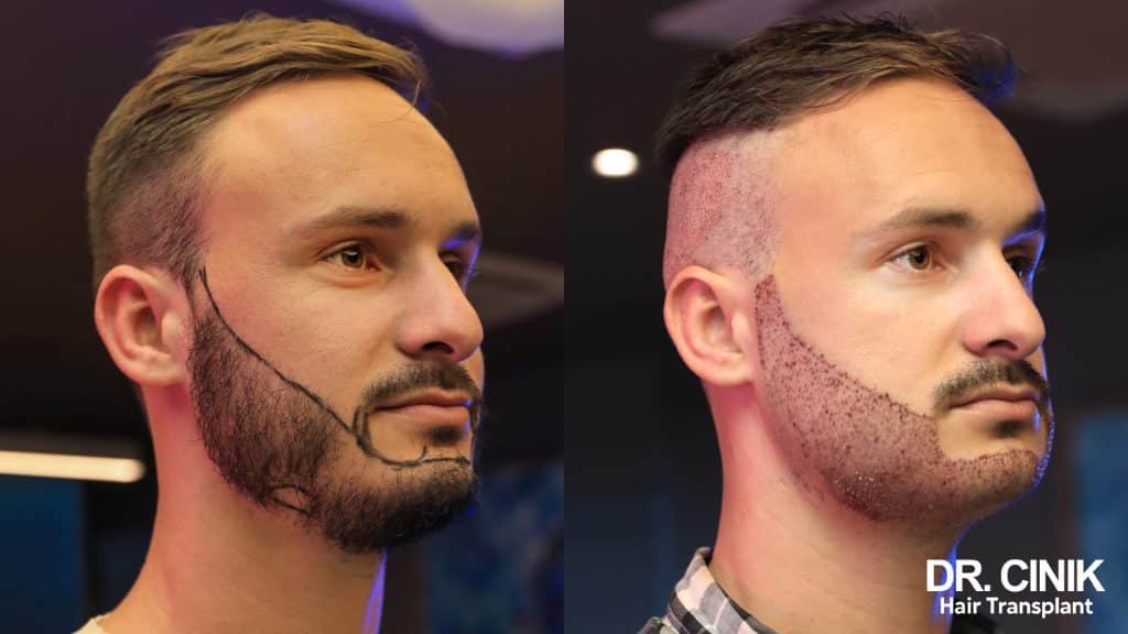 Beard Transplant Turkey: Why More Men Are Choosing Facial Hair Implants in 2024 1 01 Cinik BLOG BARBE 1024x576 1