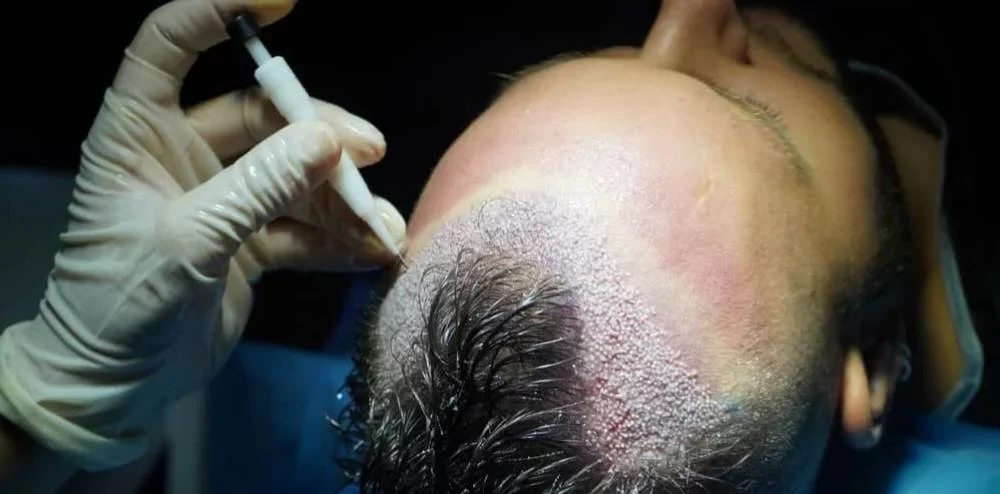 dhi hair transplant turkey.jpg e1744055749442