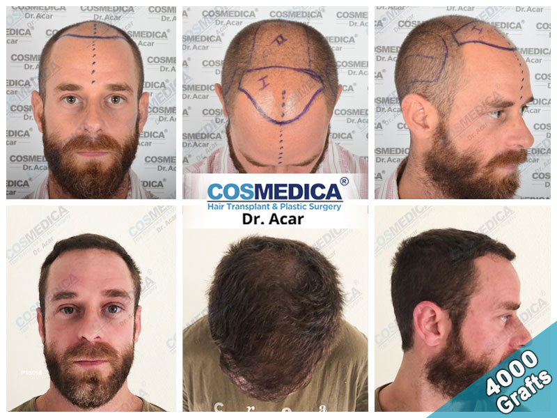 "Experience Premium Hair Transplants in Turkey with Dr. Levent Acar at Cosmedica Clinic 1 hair transplant turkey before after 4000 grafts