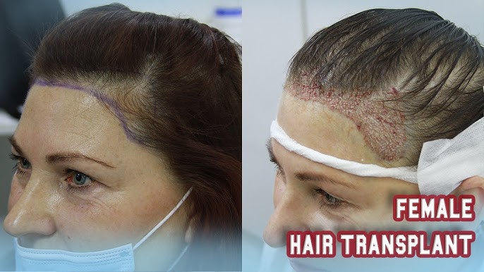 Hair Transplant for Women in Turkey: The Ultimate Confidence Boost in 2025 1 hq720 1