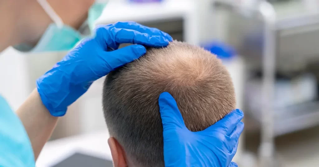 Hair Transplant Myths and Facts: Debunking the Top 15 Misconceptions in 2025 1 xC0NZuyETeWzfRU427Ym e1744056951457